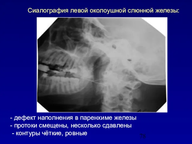 Сиалография левой околоушной слюнной железы: - дефект наполнения в паренхиме железы - протоки