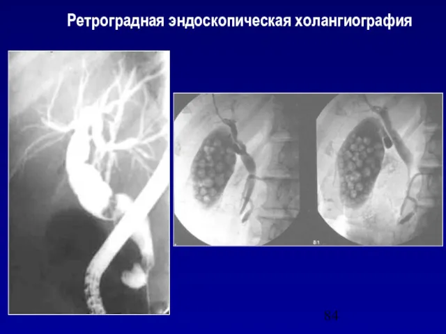 Ретроградная эндоскопическая холангиография