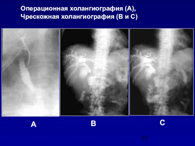 Операционная холангиография (А), Чрескожная холангиография (В и С) А В С