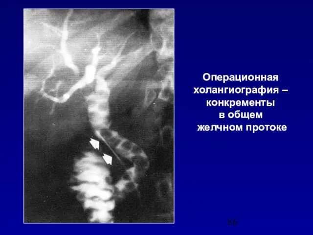 Операционная холангиография – конкременты в общем желчном протоке