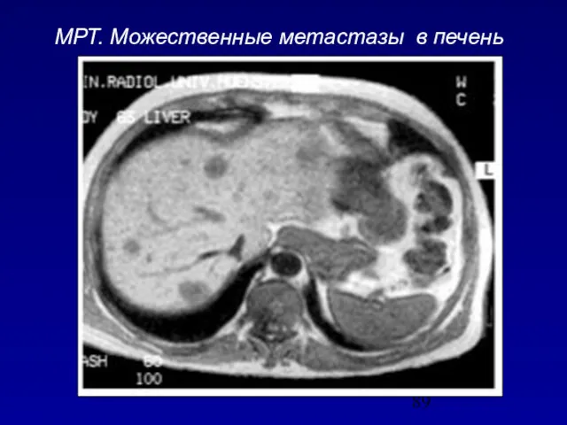 МРТ. Можественные метастазы в печень