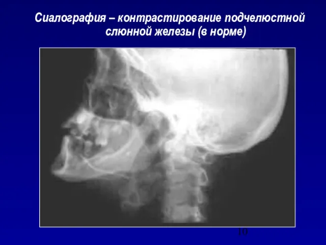 Сиалография – контрастирование подчелюстной слюнной железы (в норме)