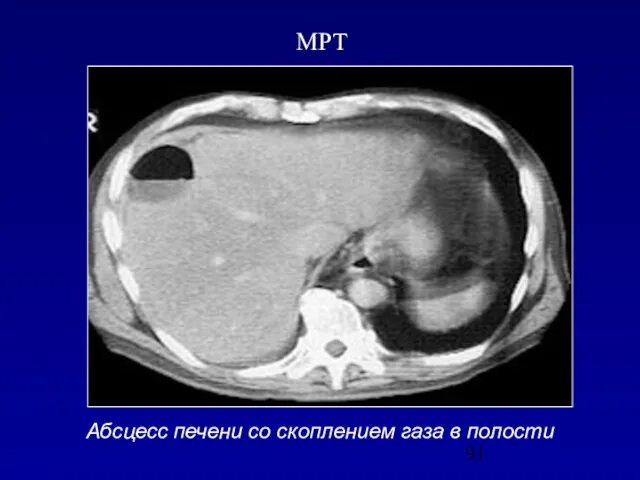 Абсцесс печени со скоплением газа в полости МРТ