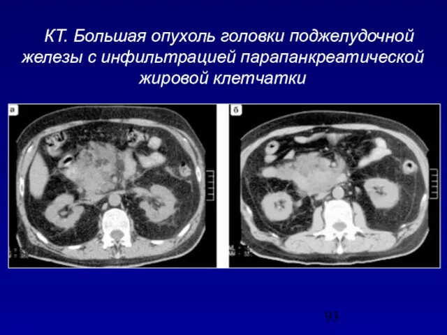 КТ. Большая опухоль головки поджелудочной железы с инфильтрацией парапанкреатической жировой клетчатки