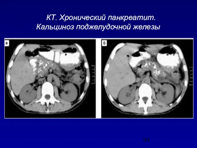 КТ. Хронический панкреатит. Кальциноз поджелудочной железы
