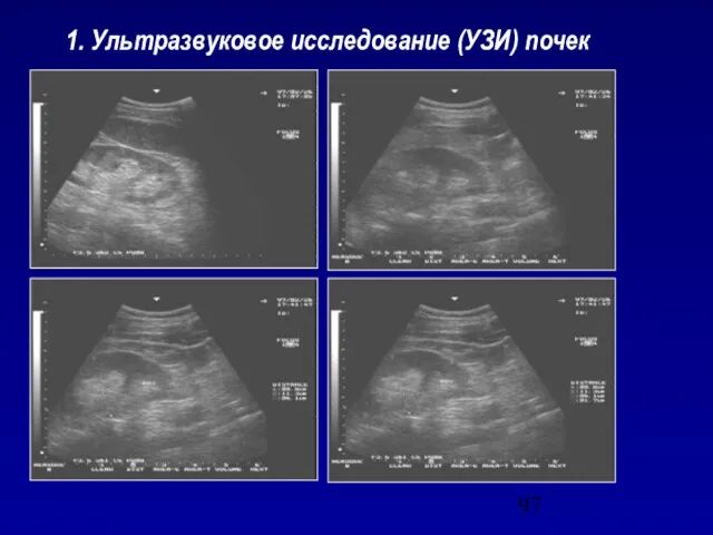 1. Ультразвуковое исследование (УЗИ) почек