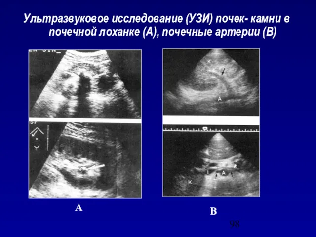 Ультразвуковое исследование (УЗИ) почек- камни в почечной лоханке (А), почечные артерии (В) А В