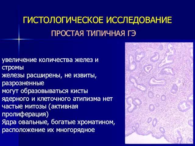 ПРОСТАЯ ТИПИЧНАЯ ГЭ ГИСТОЛОГИЧЕСКОЕ ИССЛЕДОВАНИЕ увеличение количества желез и стромы