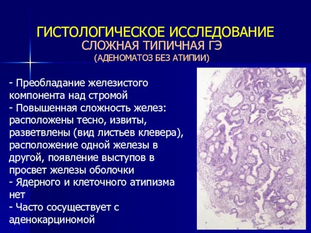 СЛОЖНАЯ ТИПИЧНАЯ ГЭ (АДЕНОМАТОЗ БЕЗ АТИПИИ) ГИСТОЛОГИЧЕСКОЕ ИССЛЕДОВАНИЕ - Преобладание