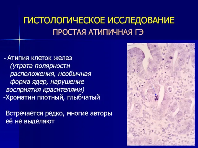 ПРОСТАЯ АТИПИЧНАЯ ГЭ ГИСТОЛОГИЧЕСКОЕ ИССЛЕДОВАНИЕ Атипия клеток желез (утрата полярности