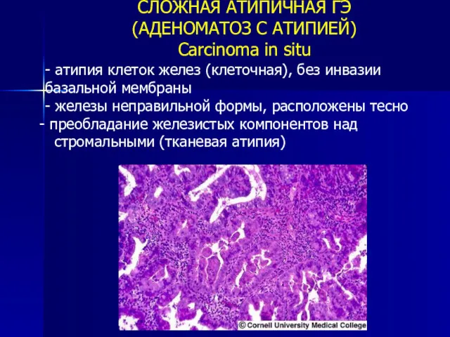 СЛОЖНАЯ АТИПИЧНАЯ ГЭ (АДЕНОМАТОЗ С АТИПИЕЙ) Carcinoma in situ -