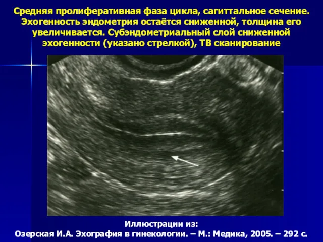 Средняя пролиферативная фаза цикла, сагиттальное сечение. Эхогенность эндометрия остаётся сниженной,