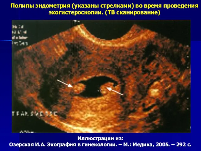 Полипы эндометрия (указаны стрелками) во время проведения эхогистероскопии. (ТВ сканирование)