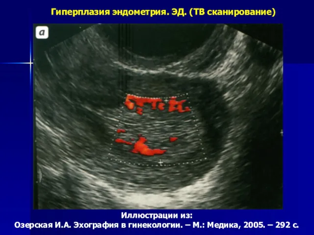 Гиперплазия эндометрия. ЭД. (ТВ сканирование) Иллюстрации из: Озерская И.А. Эхография