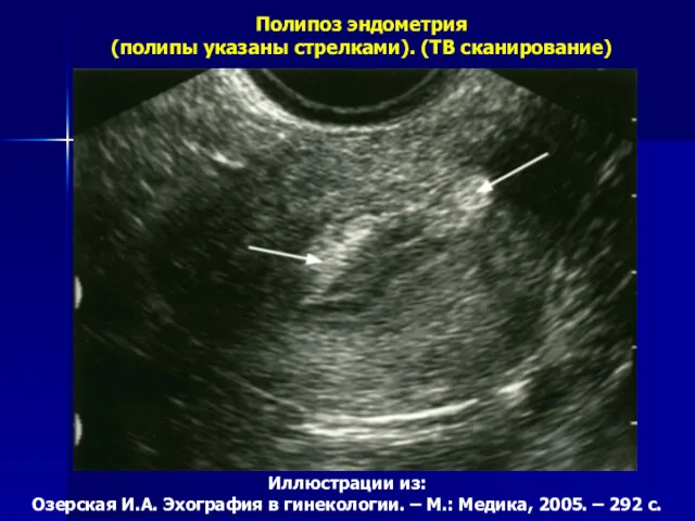 Полипоз эндометрия (полипы указаны стрелками). (ТВ сканирование) Иллюстрации из: Озерская
