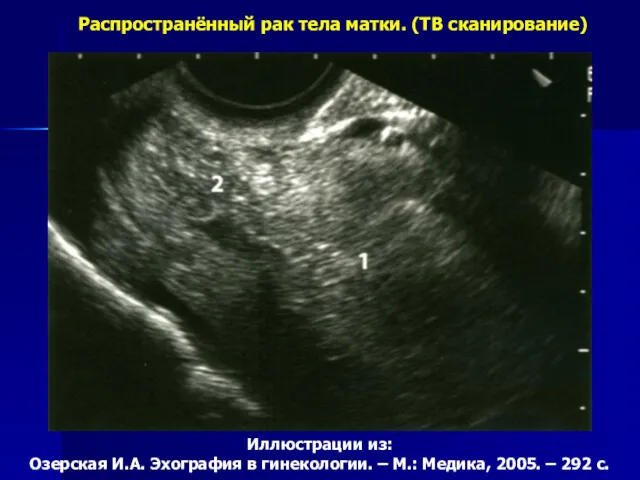 Распространённый рак тела матки. (ТВ сканирование) Иллюстрации из: Озерская И.А.