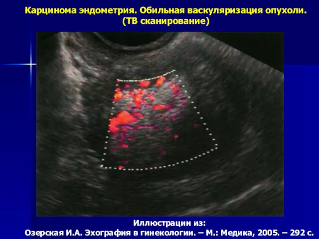 Карцинома эндометрия. Обильная васкуляризация опухоли. (ТВ сканирование) Иллюстрации из: Озерская