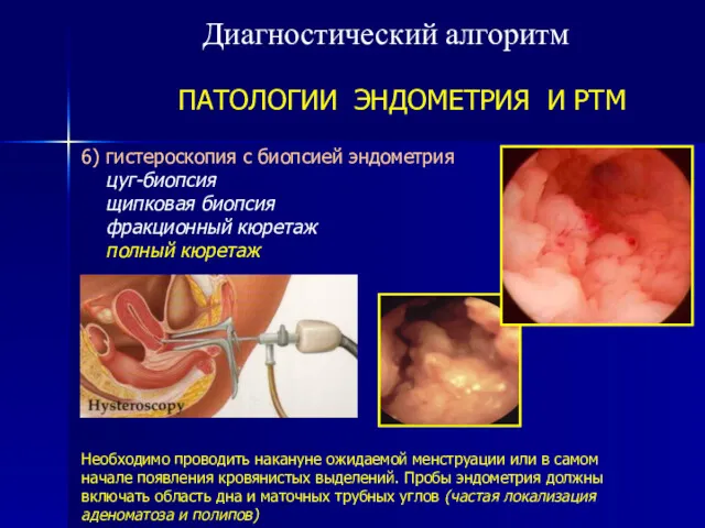 Диагностический алгоритм ПАТОЛОГИИ ЭНДОМЕТРИЯ И РТМ 6) гистероскопия с биопсией