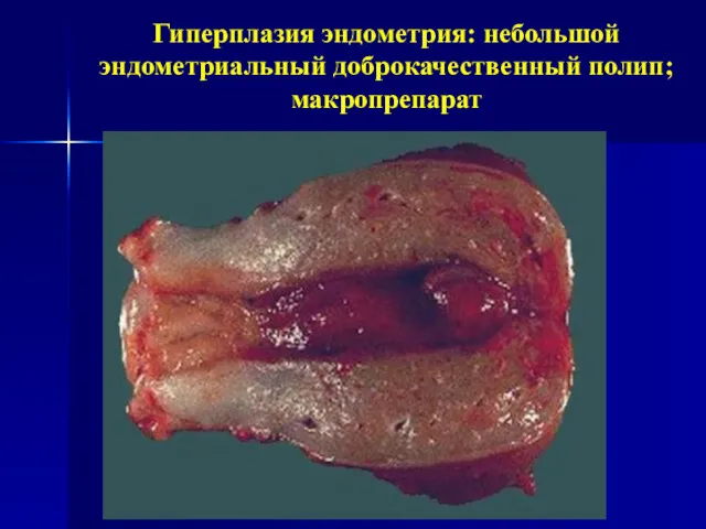 Гиперплазия эндометрия: небольшой эндометриальный доброкачественный полип; макропрепарат