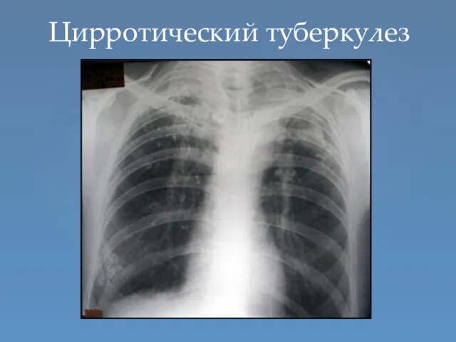 Цирротический туберкулез