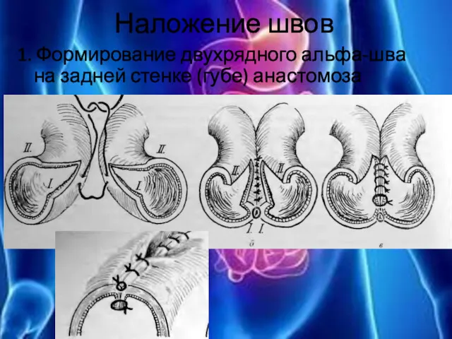 Наложение швов 1. Формирование двухрядного альфа-шва на задней стенке (губе) анастомоза