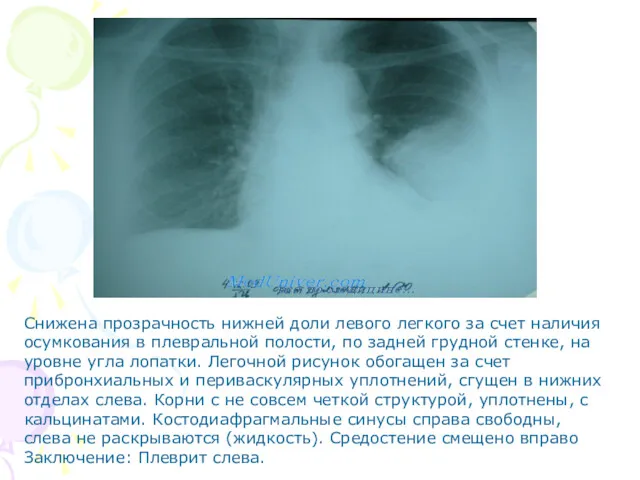 Снижена прозрачность нижней доли левого легкого за счет наличия осумкования