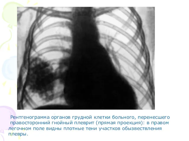 Рентгенограмма органов грудной клетки больного, перенесшего правосторонний гнойный плеврит (прямая