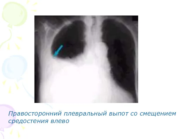 Правосторонний плевральный выпот со смещением средостения влево