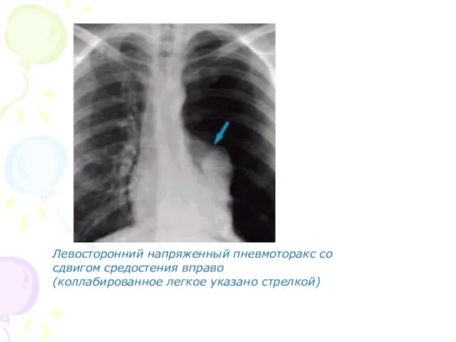 Левосторонний напряженный пневмоторакс со сдвигом средостения вправо (коллабированное легкое указано стрелкой)