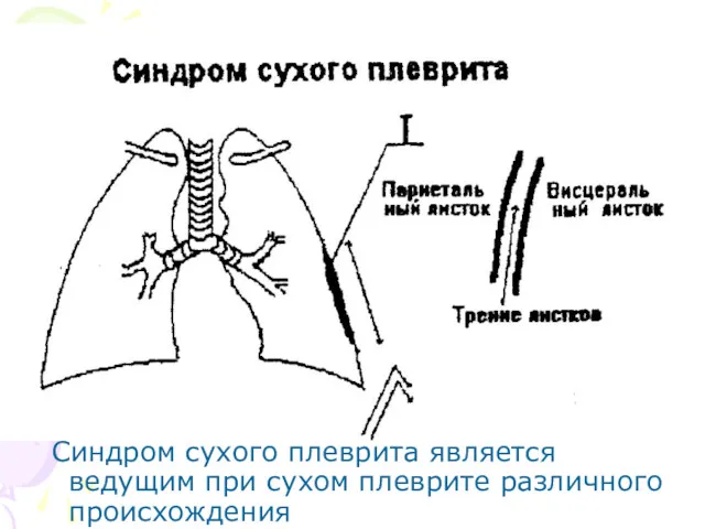 Синдром сухого плеврита является ведущим при сухом плеврите различного происхождения