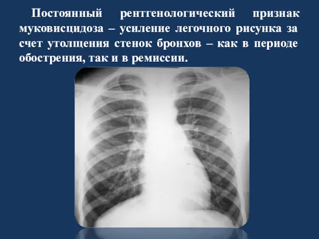 Постоянный рентгенологический признак муковисцидоза – усиление легочного рисунка за счет утолщения стенок бронхов