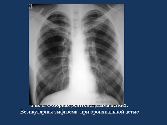 Рис 1. Обзорная рентгенограмма легких. Везикулярная эмфизема при бронхиальной астме