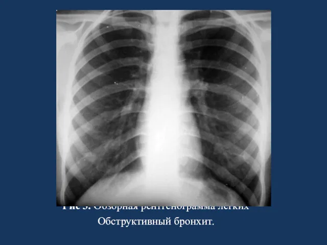 Рис 3. Обзорная рентгенограмма легких Обструктивный бронхит.