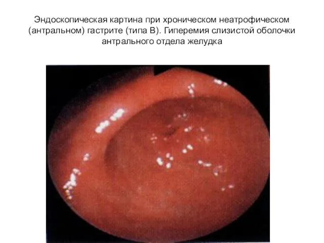 Эндоскопическая картина при хроническом неатрофическом(антральном) гастрите (типа В). Гиперемия слизистой оболочки антрального отдела желудка