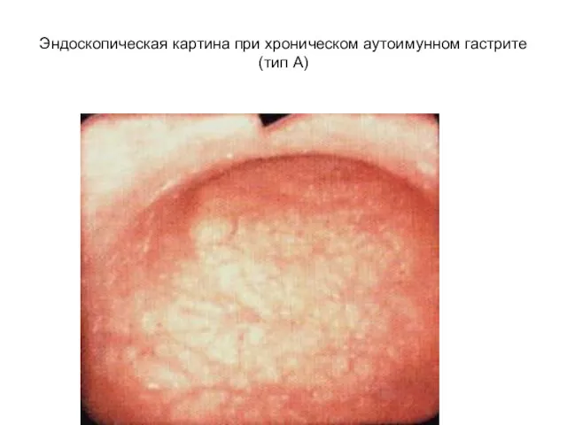 Эндоскопическая картина при хроническом аутоимунном гастрите (тип А)