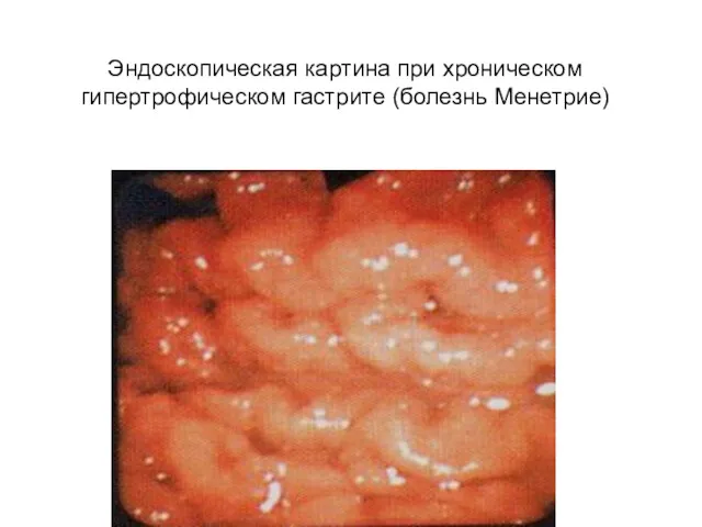 Эндоскопическая картина при хроническом гипертрофическом гастрите (болезнь Менетрие)