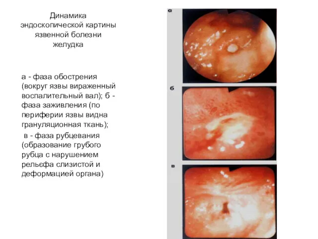 Динамика эндоскопической картины язвенной болезни желудка а - фаза обострения(вокруг язвы вираженный воспалительный