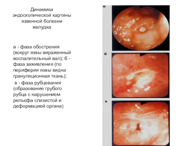 Динамика эндоскопической картины язвенной болезни желудка а - фаза обострения(вокруг
