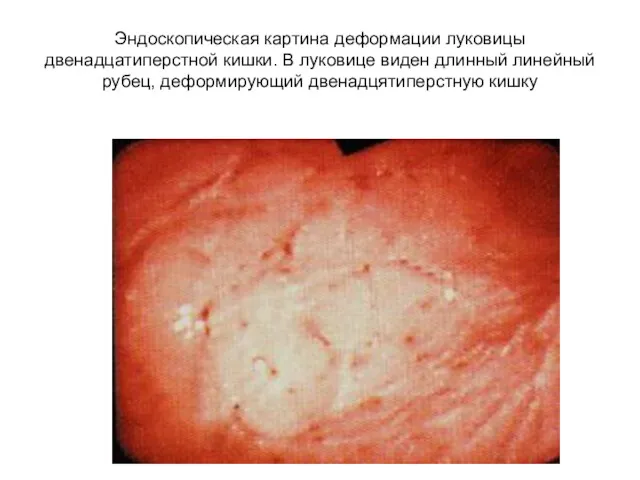 Эндоскопическая картина деформации луковицы двенадцатиперстной кишки. В луковице виден длинный линейный рубец, деформирующий двенадцятиперстную кишку