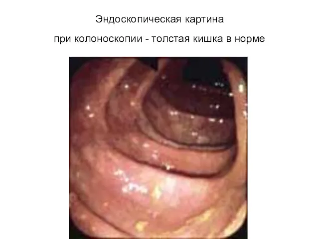 Эндоскопическая картина при колоноскопии - толстая кишка в норме