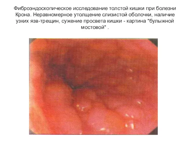 Фиброэндоскопическое исследование толстой кишки при болезни Крона. Неравномерное утолщение слизистой