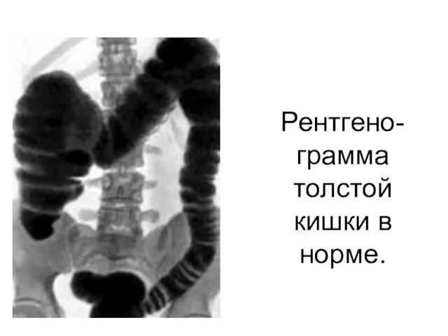 Рентгено-грамма толстой кишки в норме.