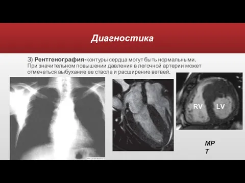 Диагностика 3) Рентгенография-контуры сердца могут быть нормальными. При значительном повышении