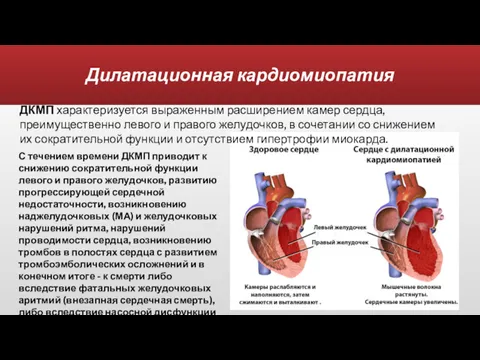 Дилатационная кардиомиопатия ДКМП характеризуется выраженным расширением камер сердца, преимущественно левого