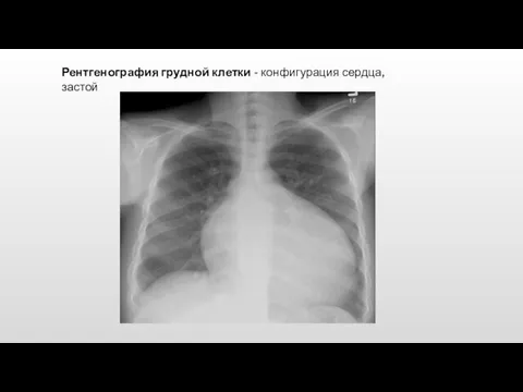 Рентгенография грудной клетки - конфигурация сердца, застой