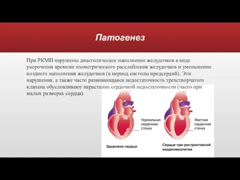 Патогенез При РКМП нарушены диастолическое наполнение желудочков в виде укорочения