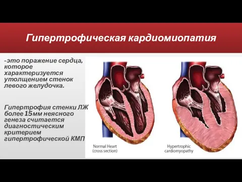 Гипертрофическая кардиомиопатия -это поражение сердца, которое характеризуется утолщением стенок левого