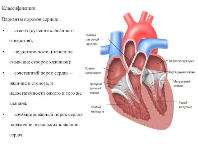 Классификация Варианты пороков сердца: стеноз (сужение клапанного отверстия); недостаточность (неполное смыкание створок клапанов);