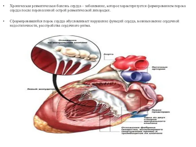 Хроническая ревматическая болезнь сердца – заболевание, которое характеризуется формированием порока