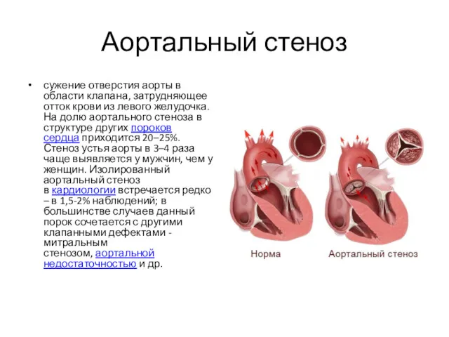 Аортальный стеноз сужение отверстия аорты в области клапана, затрудняющее отток крови из левого